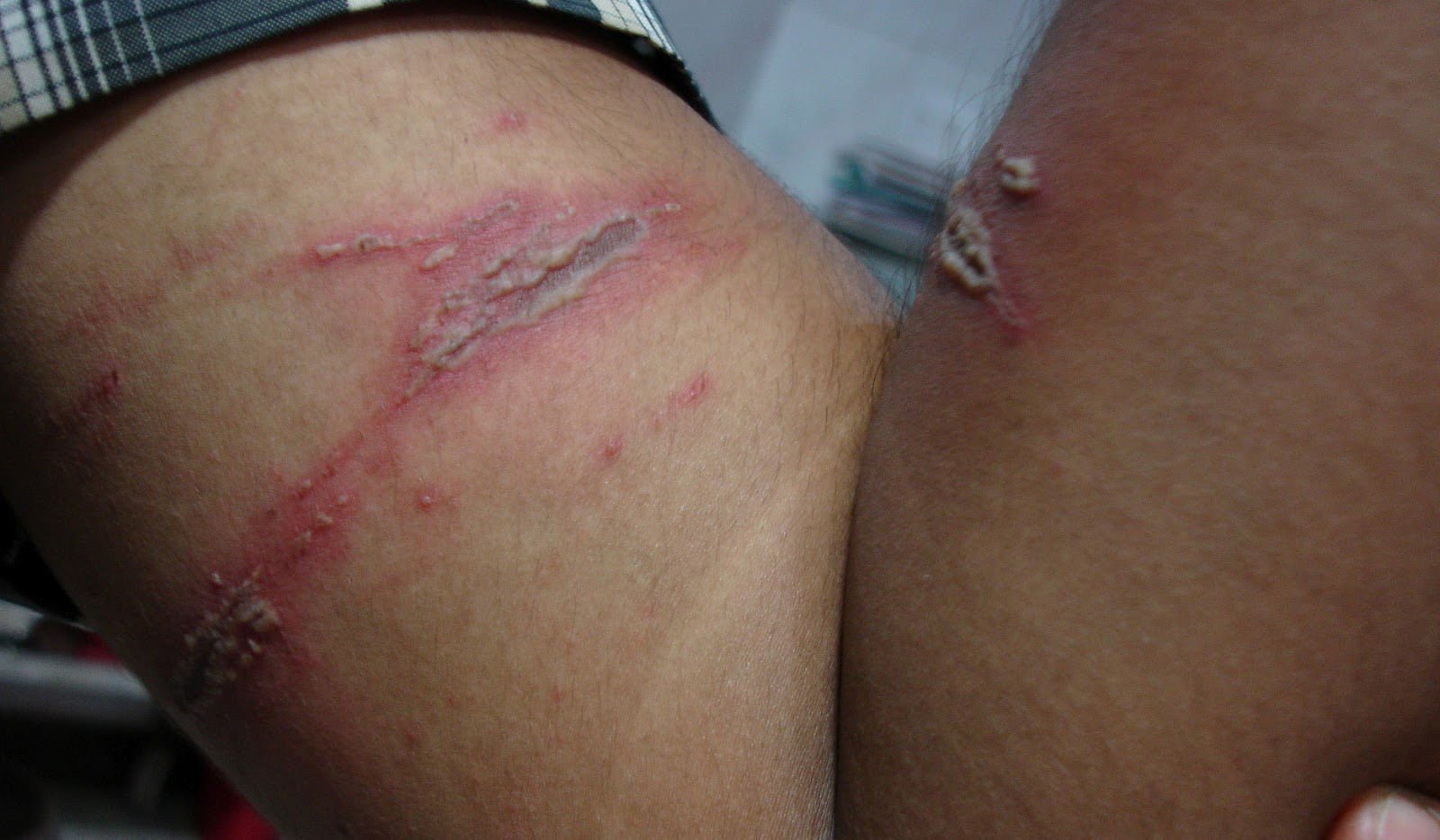 paederus_dermatitis_kissing_lesions_1_061030